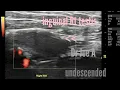 Undescended testis or cryptorchidism inguinal testis sonography ultrasound and color Doppler