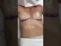 Breast Augmentation I Performed This Morning