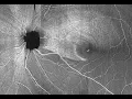 RNFL Optical Texture Analysis ROTA