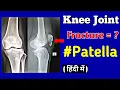 How to read Knee joint Fracture X-Ray Fracture Patella bone Uday Xray