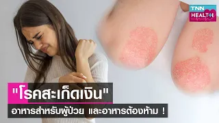 ผู้ป่วยโรคสะเก็ดเงินควรหลีกเลี่ยงอาหารประเภทไหนบ้าง และทำไม