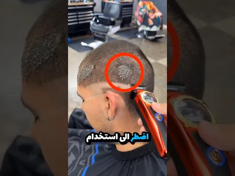 لن تُصَدِّقَ ما وجده الحلاق داخل شعر هذا الطفل 😱🪳