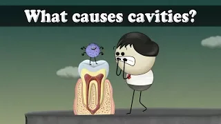 What causes cavities