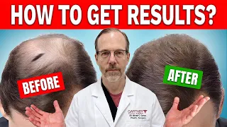 Why Your Hair Loss Treatment Failed