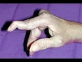 Tenotomy Finger CPT code - simplify medical coding