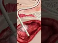 Download Lagu urinary catheter