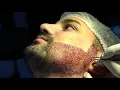 Download Lagu BEARD TRANSPLANTATION PROCEDURE // MODERN TECHNOLOGY OF BEARD GROWTH