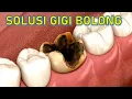 Download Lagu Bukan DICABUT bukan DITAMBAL‼️ Ini solusi GIGI BERLUBANG‼️
