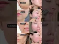 Download Lagu Quick Gua Sha moves for #doublechin #smilelines #tmj #sculptedface