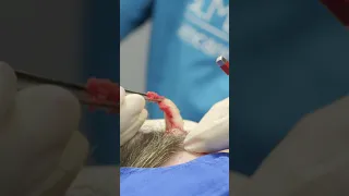 Craziest Pops Compilation Dr Pimple Popper TLC 