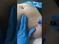 Stretch Mark Inkless Removal Boleyn Treatment