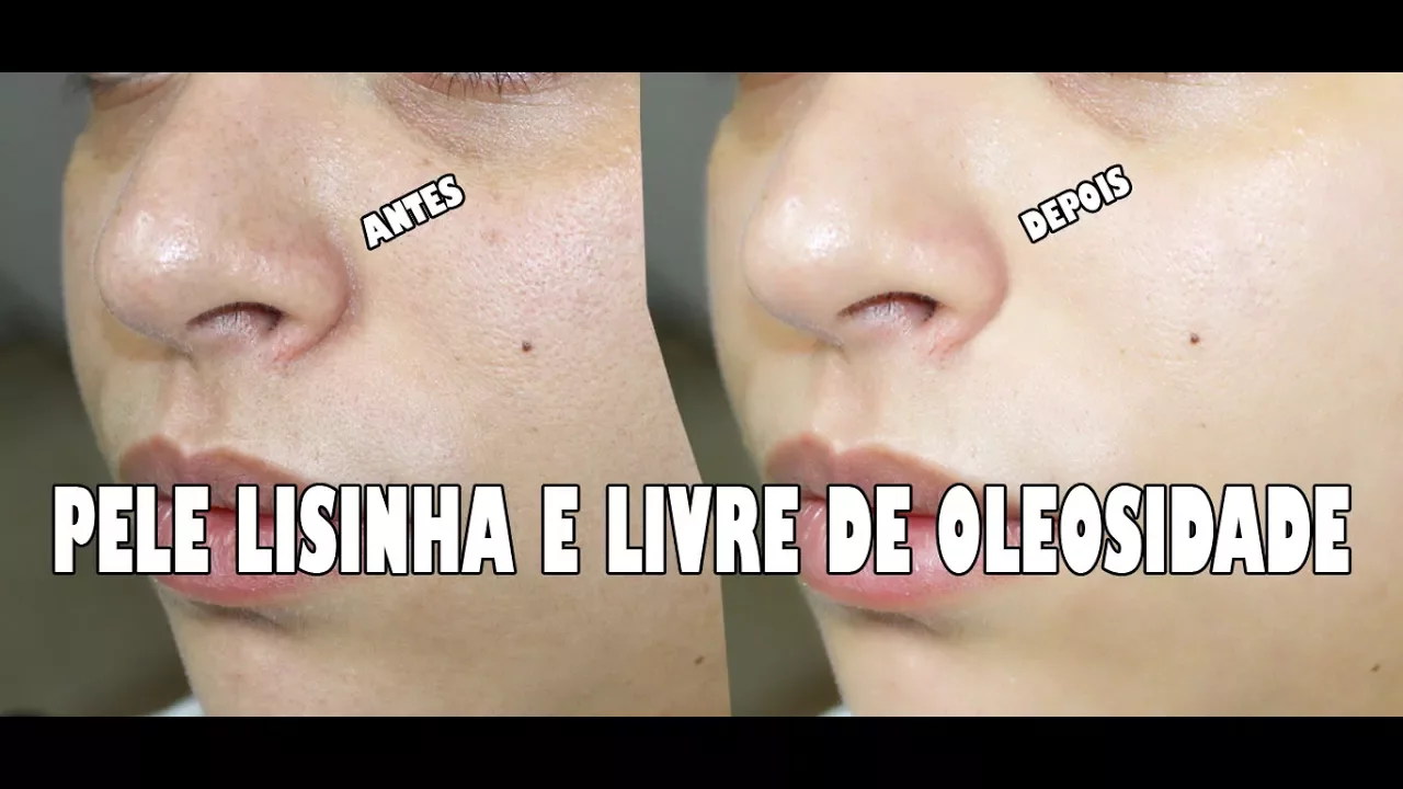 LASER DE CO2 FRACIONADO - COMO FOI MEU PÓS LASER - DOEU???? GOSTEI???