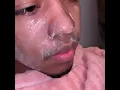 BlackHead Removal Facial