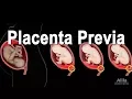 Low Lying Placenta - Placenta Previa Animation
