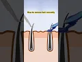 Download Lagu Laser hair removal can penetrate deep into the hair follicles, which can inhibit hair growth#hair