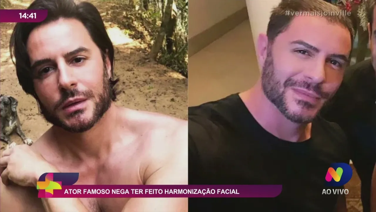 Ator famoso nega ter feito harmonização facial