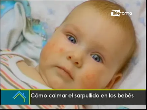 Cómo calcar el sarpullido en los bebés