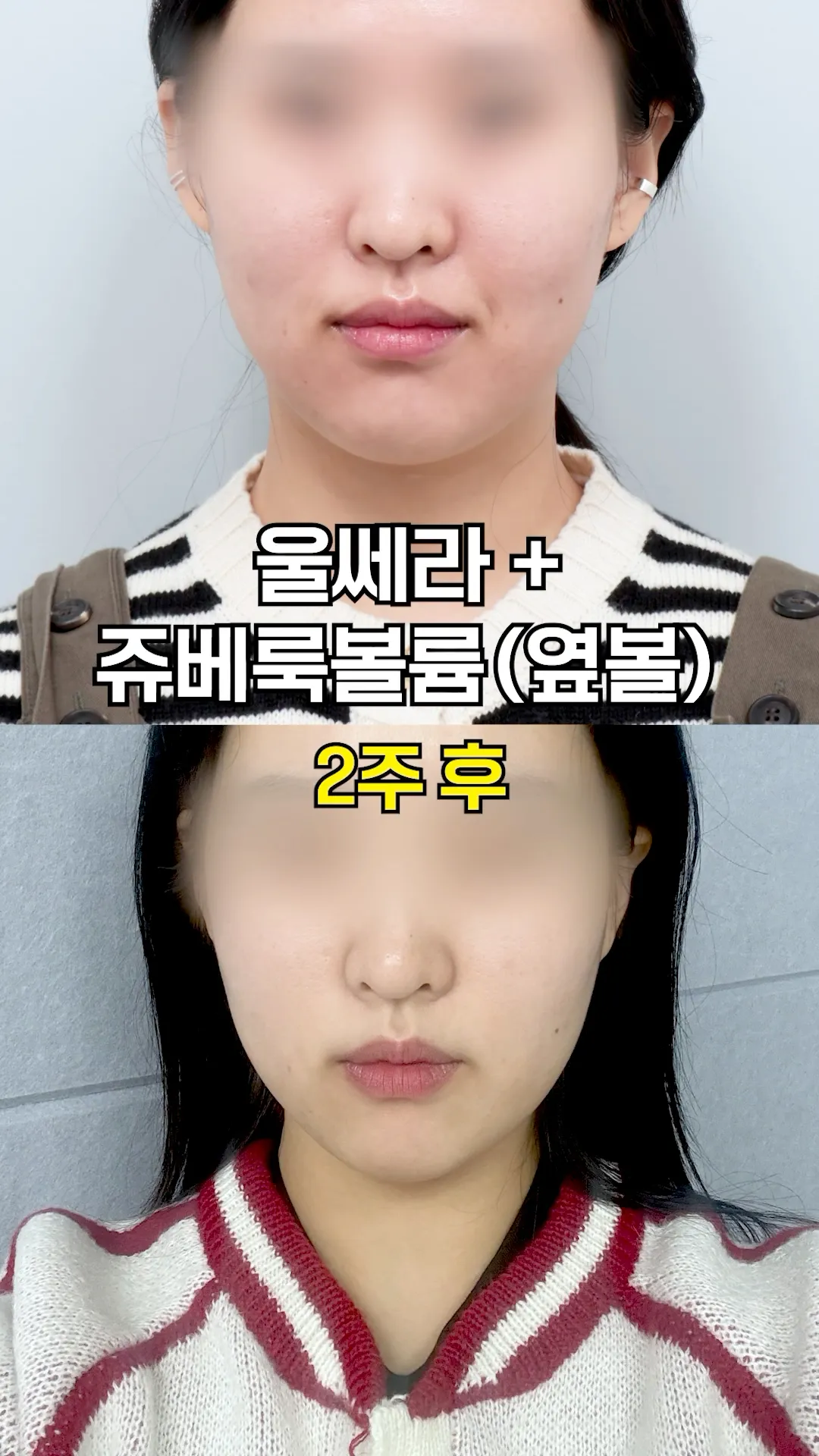 효과 좋은 피부시술 조합