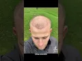 Download Lagu HAIR TRANSPLANT BEFORE AFTER - 11 MONTHS