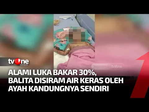 Kondisi Balita 2 Tahun Korban Penyiraman Air Keras Ayah Kandungnya