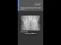 Evaluating the AP Pelvis Radiograph for THA Planning