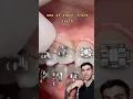 Using Braces To Fix A Missing A Front Tooth