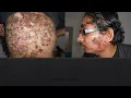 Download Lagu Syndromes in acne