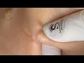 Acne Treament Under The Skin