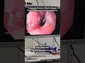 Download Lagu Revision Endoscopica de Bypass Gastrico - TORe procedure