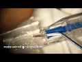 Download Lagu Loading and Implantation of the Bausch+Lomb enVista Intraocular Lens Implant