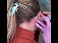 1st treatment of tattoo behind the ear