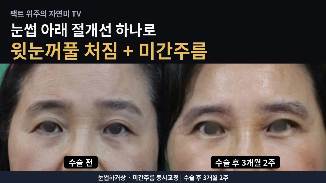 눈썹하거상 + 미간주름 동시교정｜60대 초반 여성 수술 후 3개월 2주#눈썹하거상 #미간주름 #미간주름근본교정 #윗눈꺼풀처짐 #중년눈성형