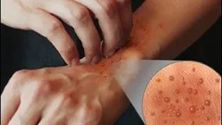 كل ما تريد معرفتة عن حمو النيل               الأسباب   العلاج     ما هو علاج حمو النيل   دندنها