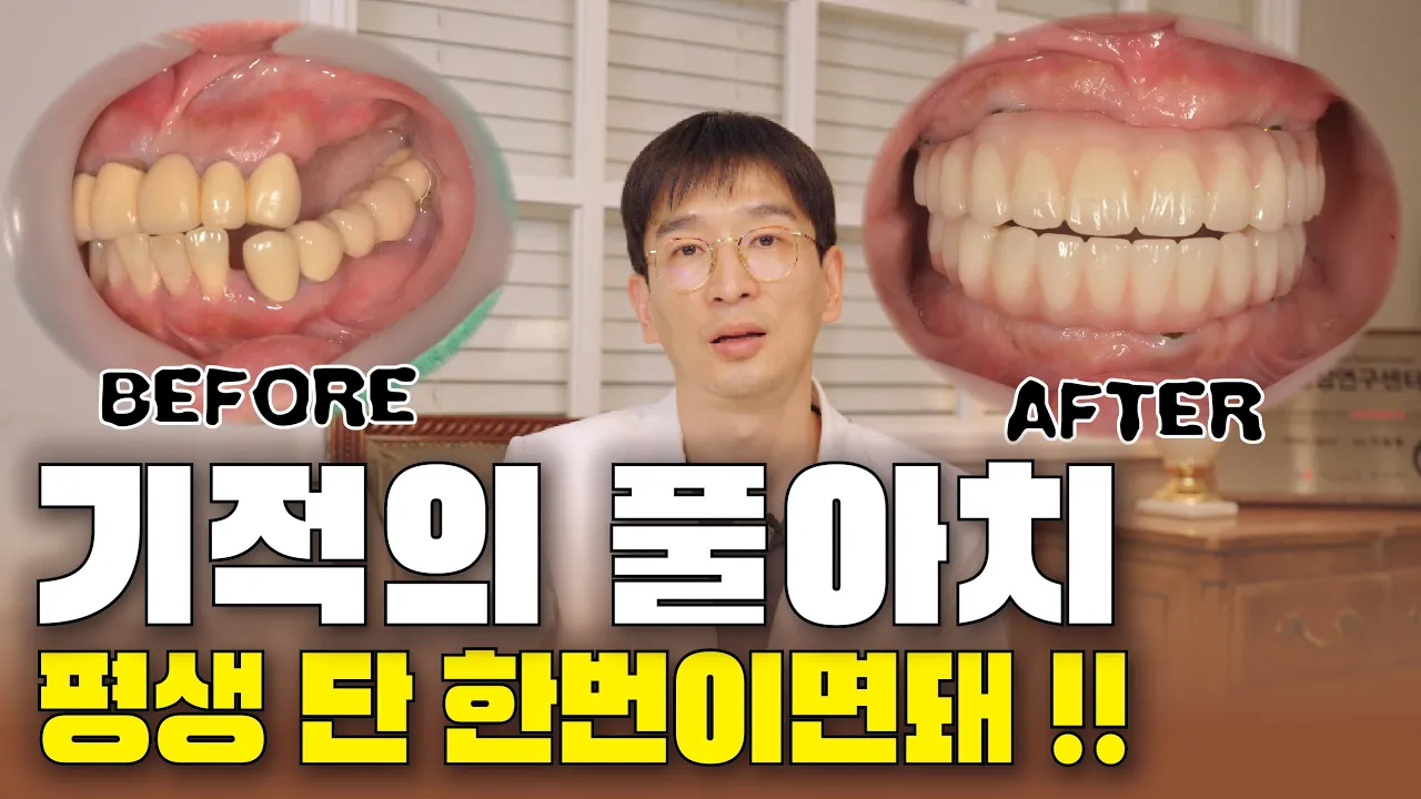틀니같은 틀니대신 틀니아닌전체 풀아치임플란트 비밀을 파해칩니다!!