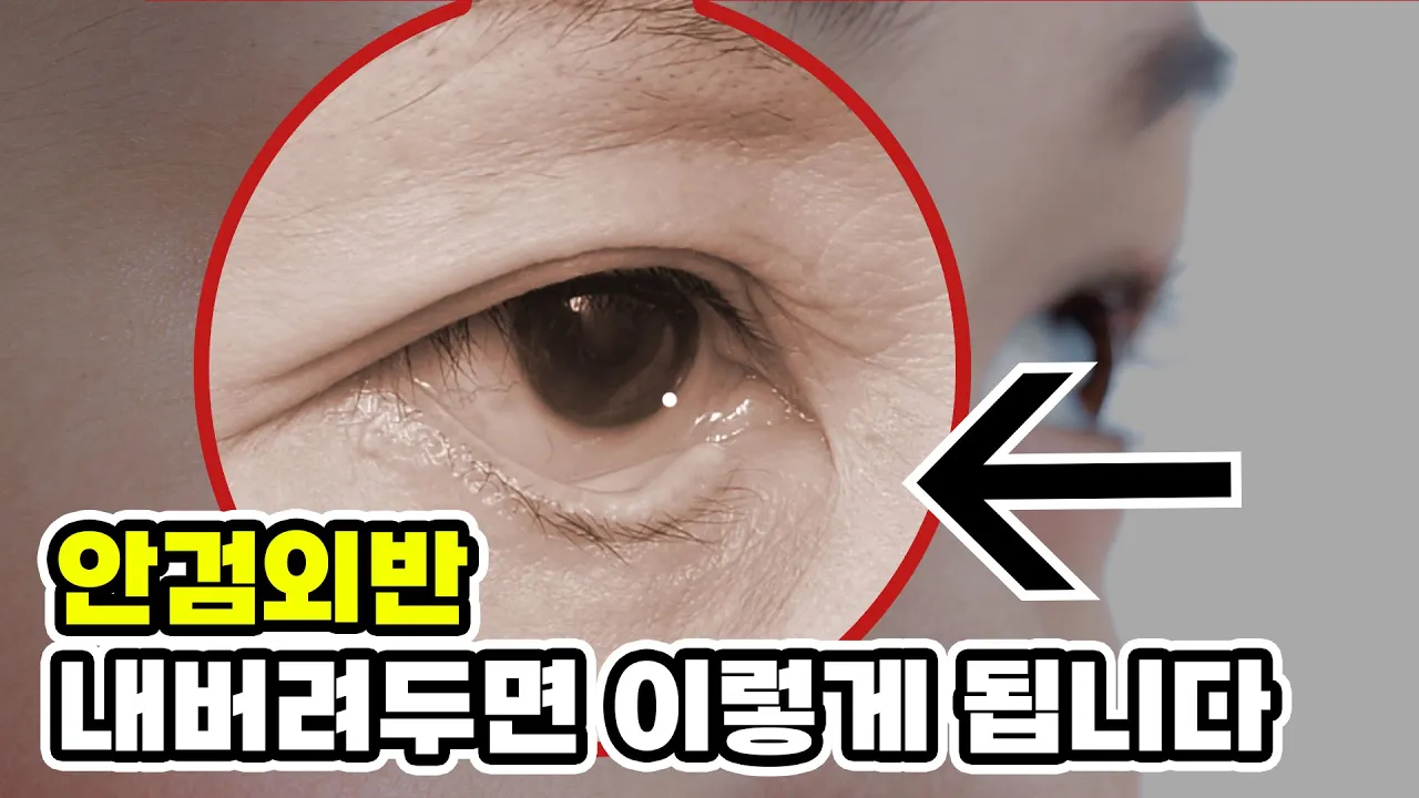 저 눈꺼풀이 뒤집어졌어요! 개선방법은?│안검외반 수술전후 다양한 케이스 모음!