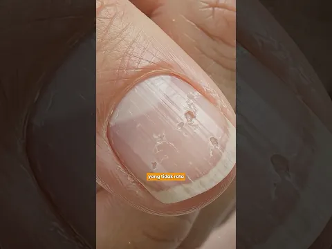 Ternyata Ini Penyebab Bercak Putih di Kuku 💅👀