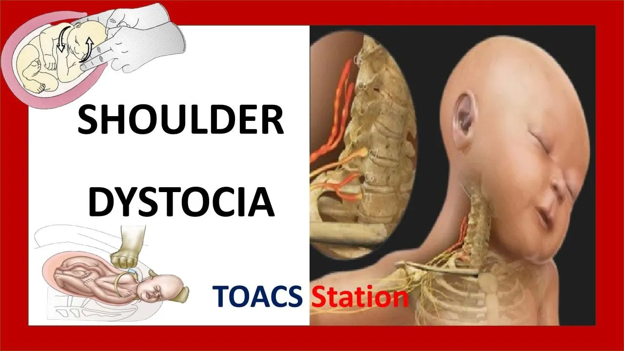 Shoulder Dystocia | TOACS and OSCE Station