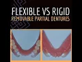 V2538 Flexible vs Rigid Removable Partial Dentures