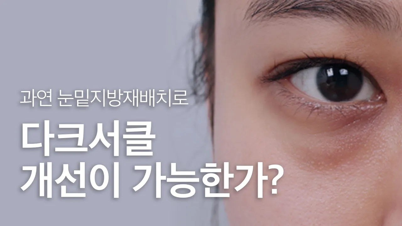 눈밑 지방...눈밑지방재배치로 해결😲 다크서클까지 개선❓❗