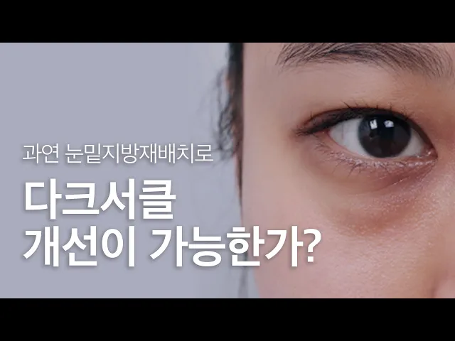 눈밑 지방...눈밑지방재배치로 해결😲 다크서클까지 개선❓❗