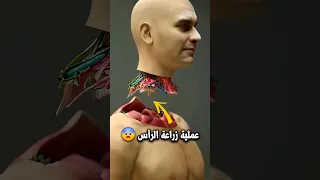 عمليه زراعه الرأس بالتفصيل Shorts 