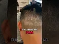 Download Lagu FUE Hair Transplant Scar COVER-UP #scalpmicropigmentation #hairloss #hairtattoo #scar #scarskin