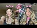 GETTING 1 SYRINGE RESTYLANE KYSEE LIP FILLER pain level aftercare 2 weeks healing