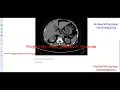 Kidney Stone Detection Using Image Processing Python Project With Source Code Identify Kidney Stone