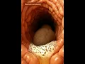 Download Lagu “Real Footage of Constipation Blocking the Colon”