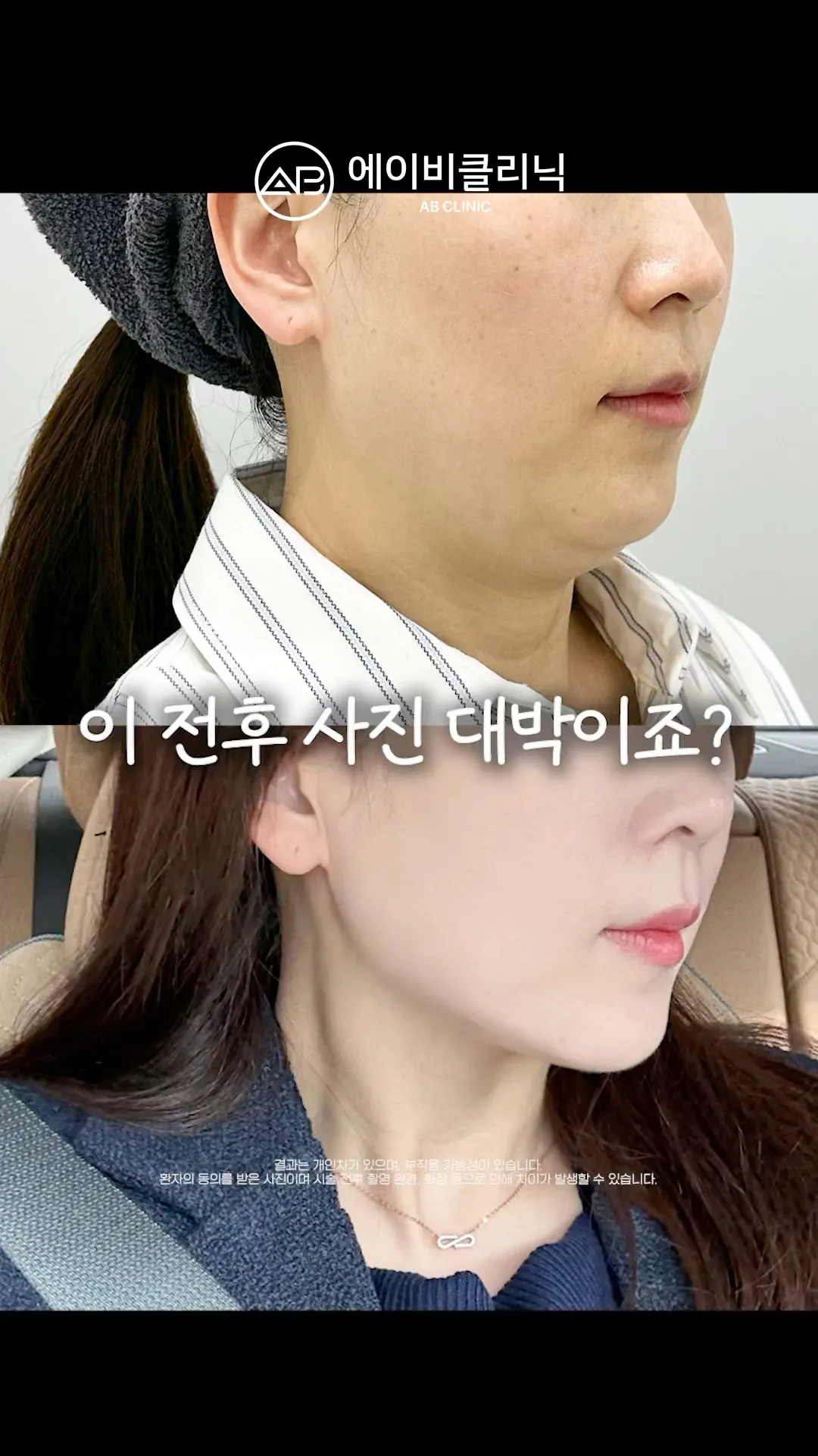 울쎄라 효과 간접 체험하기 ⚡