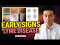 Tick Bite Watch for These Early Lyme Disease Symptoms
