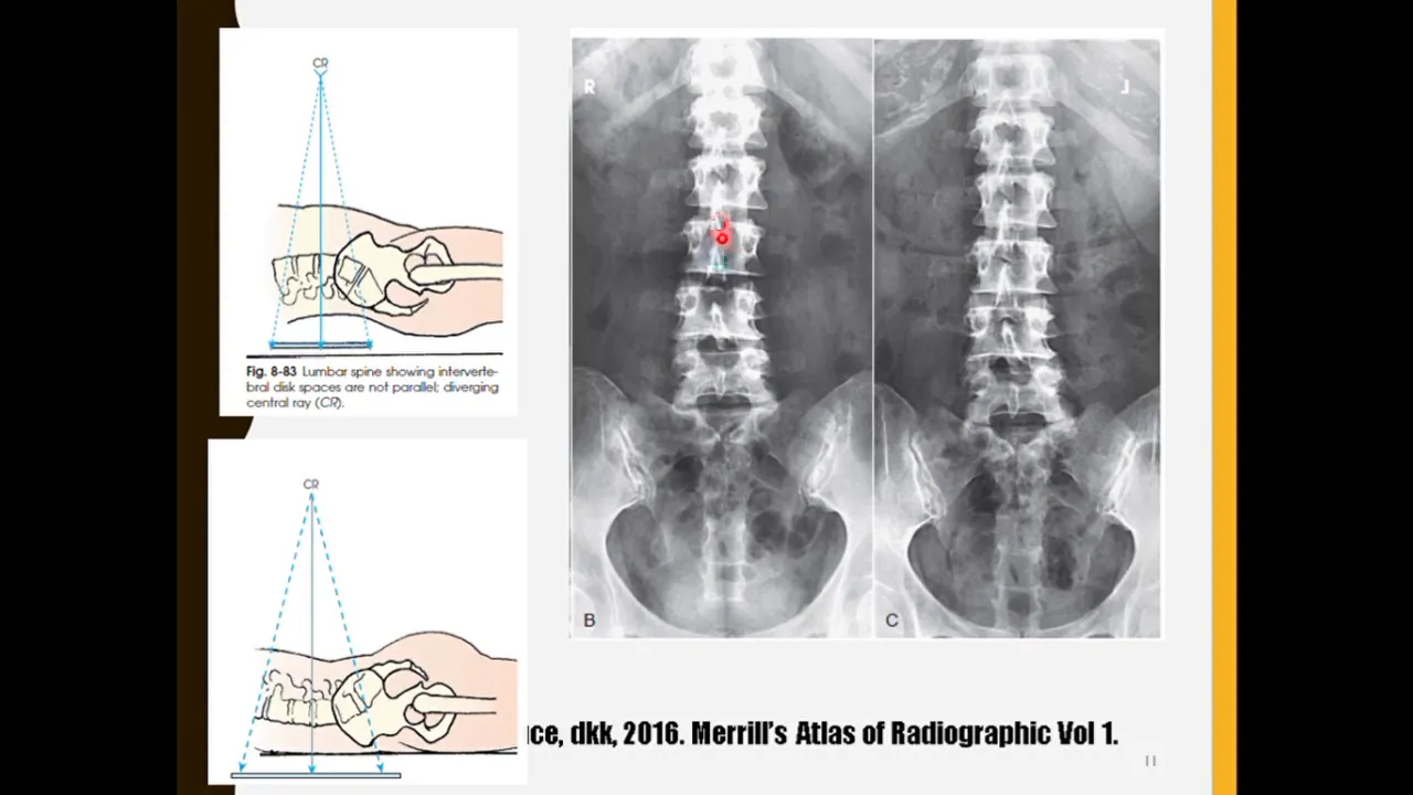 MRI OF LUBAR ON CASE HNP. 