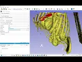 Extracting Surface Mesh Geometry from DICOM Medical Data Using SLICER 3D