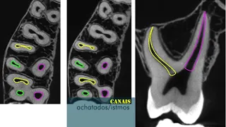 Anatomia e abertura coronária do Molar Superior